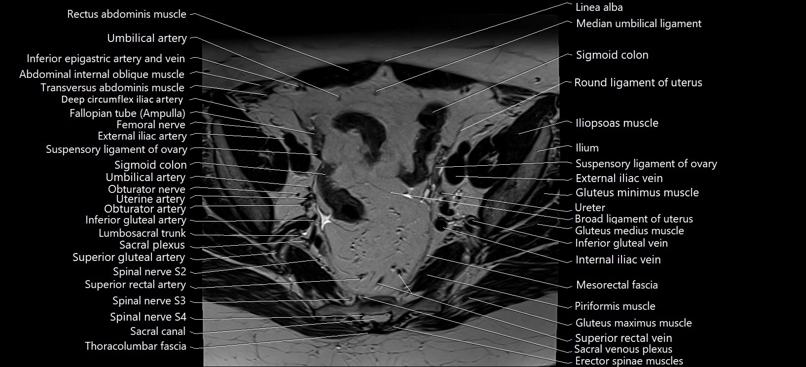Axial cross sectional anatomy of female pelvis (MRI 3T) image 11.webp